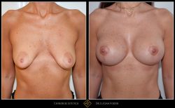 Ridicare sani / mastopexie Caz 29 Foto 2