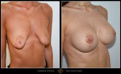 Ridicare sani / mastopexie Caz 29 Foto 3