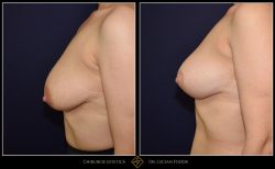 Ridicare sani / mastopexie Caz 30 Foto 1