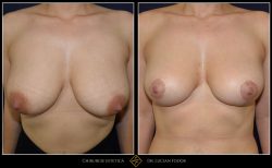 Ridicare sani / mastopexie Caz 30 Foto 2