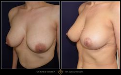 Ridicare sani / mastopexie Caz 30 Foto 3