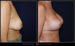 Ridicare sani / mastopexie Caz 31 Foto 1