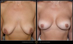 Ridicare sani / mastopexie Caz 31 Foto 2