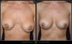 Ridicare sani / mastopexie Caz 32 Foto 0