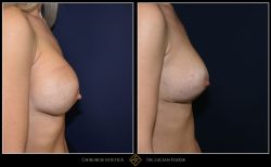 Ridicare sani / mastopexie Caz 32 Foto 2