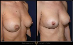 Ridicare sani / mastopexie Caz 32 Foto 3