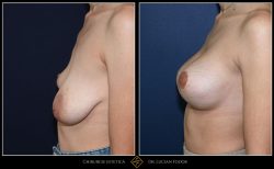 Ridicare sani / mastopexie și corectare asimetrie, Caz 34 Foto 3