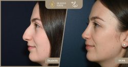 Rinoseptoplastie pentru corectarea cocoașei nazale și definirea vârfului - Caz 263 Foto 1