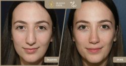 Rinoseptoplastie pentru corectarea cocoașei nazale și definirea vârfului - Caz 263 Foto 2
