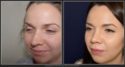 Rinoplastie / operatie la nas, Caz 192 Foto 3