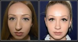 Rinoplastie / operatie la nas, Caz 194 Foto 2