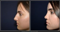 Rinoplastie / operatie la nas, Caz 198 Foto 1