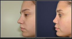 Rinoplastie / operatie la nas, Caz 200 Foto 1