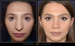 Rinoplastie / operatie la nas, Caz 207 Foto 2