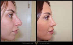 Rinoplastie / operatie la nas, Caz 208 Foto 2