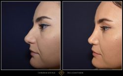 Rinoplastie / operatie la nas, Caz 210 Foto 1