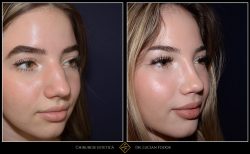 Rinoplastie / operatie la nas, Caz 215 Foto 3