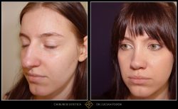 Rinoplastie / operatie la nas, Caz 219 Foto 3