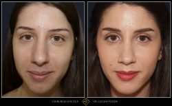 Rinoplastie / septoplastie, Caz 232 Foto 2