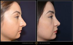 Rinoplastie / septoplastie, Caz 237 Foto 1