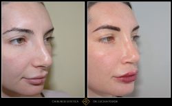 Rinoplastie / septoplastie, Caz 240 Foto 3