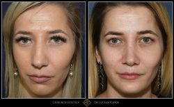 Rinoplastie - Operație nas, cu implant bărbie, Caz 255 Foto 2