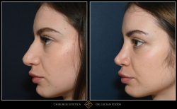 Rinoseptoplastie: remodelarea completă a nasului - Caz 261 Foto 1