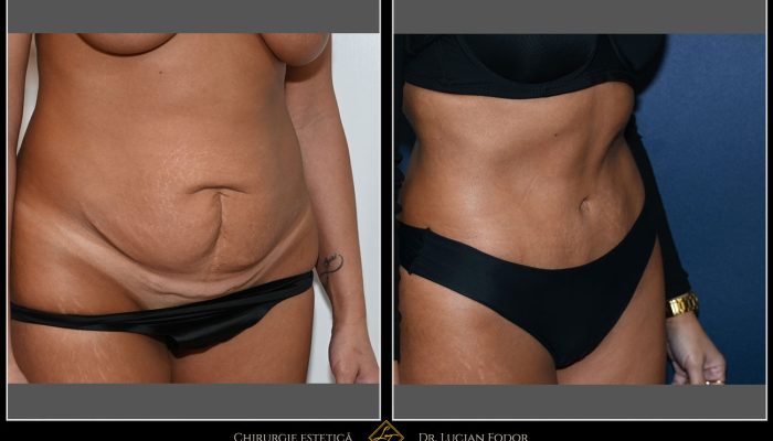 Abdominoplasty – Case 32: Correction of abdomen weakened by pregnancies and C-sections.