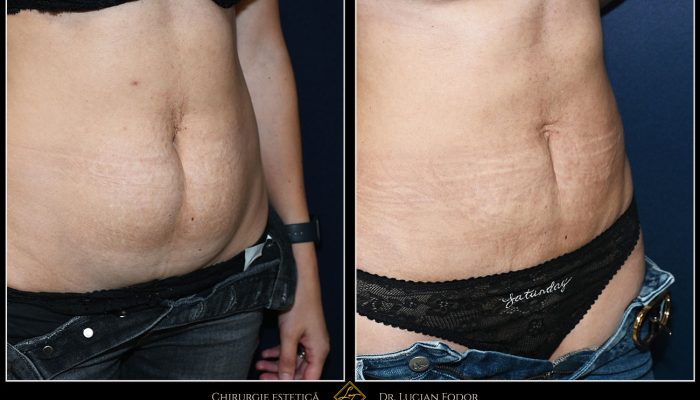 Miniabdominoplasty with Diastasis Repair and Lower Abdominal Liposuction – Case 33