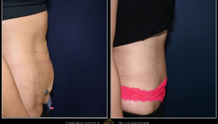 Abdominoplasty with Diastasis Repair and Pubic Lift – Restoring Core Strength and Lower Contour – Case 34