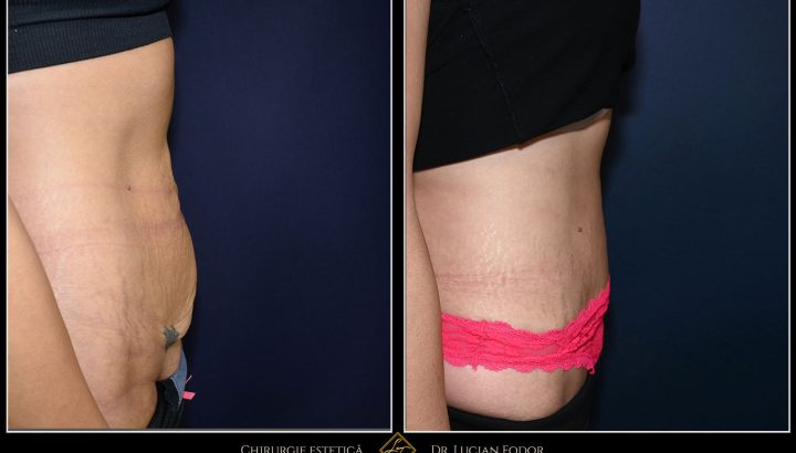 Abdominoplastie cu corectarea diastazei musculare și lifting pubian – restaurarea armoniei abdominale – Caz 34