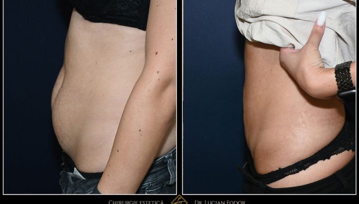 Mini abdominoplasty with liposuction and abdominal wall tightening – achieving a firm, toned abdomen – Case 35