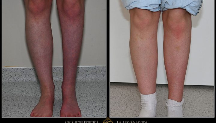 Remodelarea gambei prin implant – proporții armonioase și contur definit – Caz 05