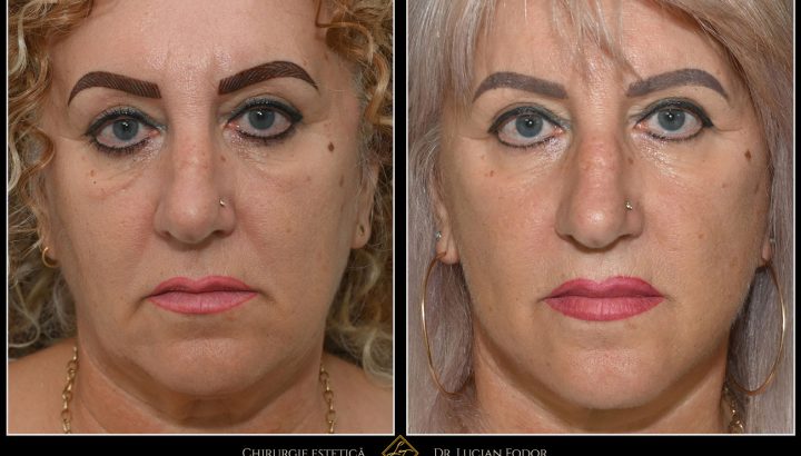 Deep Plane Facelift – natural rejuvenation and restored facial contour – Case 19