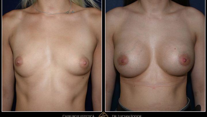 7-Year Follow-Up: Breast Augmentation with Mentor Implants – Case 102