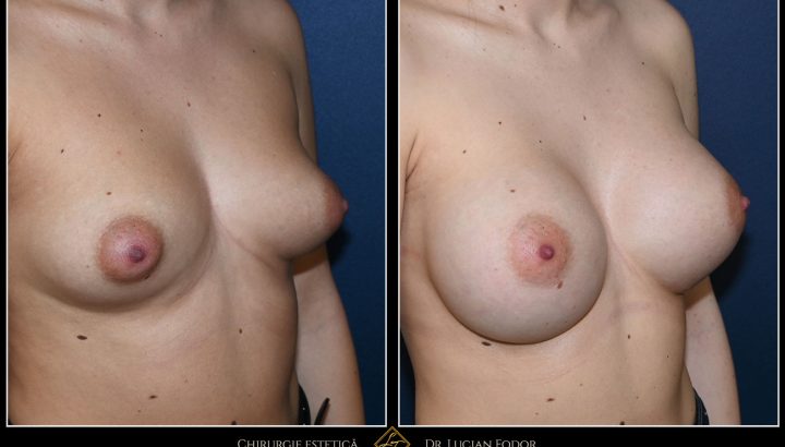 Breast augmentation with asymmetry correction – volume, balance, and harmony – Case 103