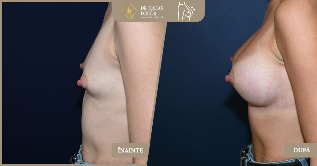 Hipoplazia mamară asociată cu asimetria cutiei toracice - Caz 104 Foto 1