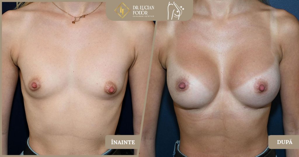Hipoplazia mamară asociată cu asimetria cutiei toracice - Caz 104 Foto 2
