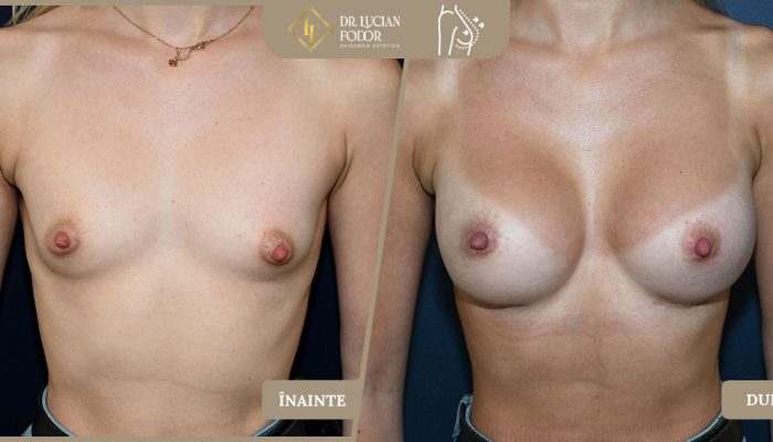 Mărire de sâni — Hipoplazia mamară asociată cu asimetria cutiei toracice – Caz 104