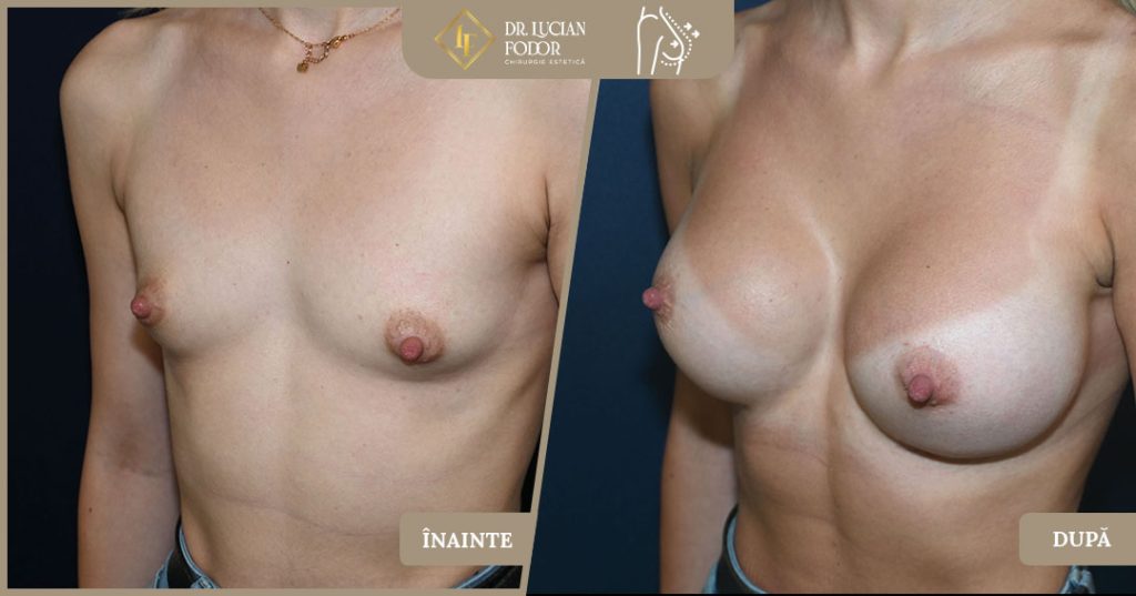 Hipoplazia mamară asociată cu asimetria cutiei toracice - Caz 104 Foto 3
