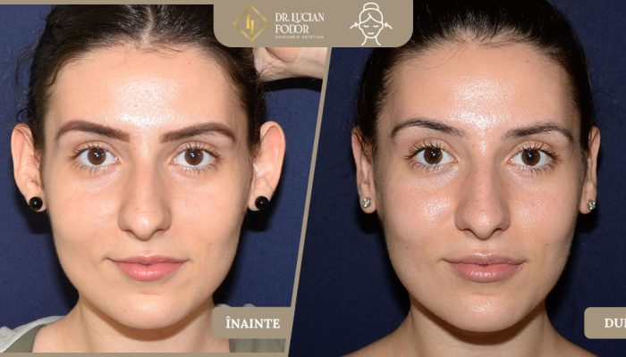 Otoplastie – Asimetrie auriculară prin malpoziția cartilajului și urechi depărtate de cap – Caz 17