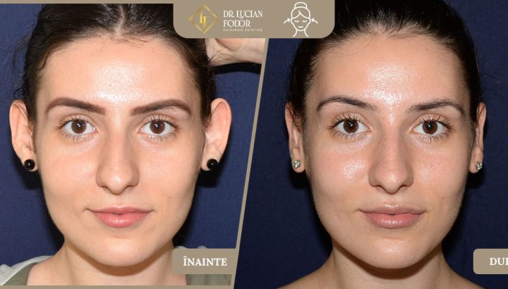 Otoplastie – Asimetrie auriculară prin malpoziția cartilajului și urechi depărtate de cap – Caz 17