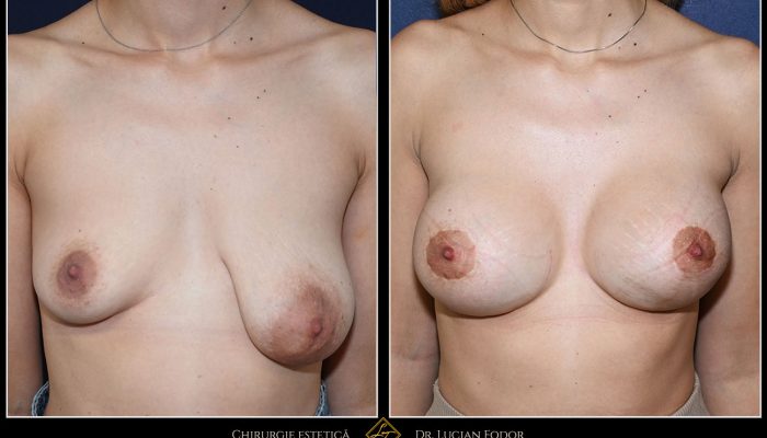 Marire sâni – Caz 101: Augmentare cu înlocuire implant