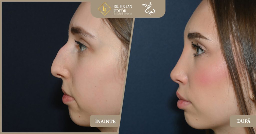 Rinoseptoplastie pentru corectarea unui nas hipertrofiat cu cocoașă și vârf nedefinit - Caz 264 Foto 1