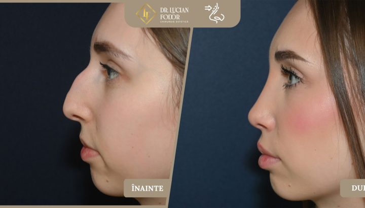 Rinoseptoplastie pentru corectarea unui nas hipertrofiat cu cocoașă și vârf nedefinit – Caz 264