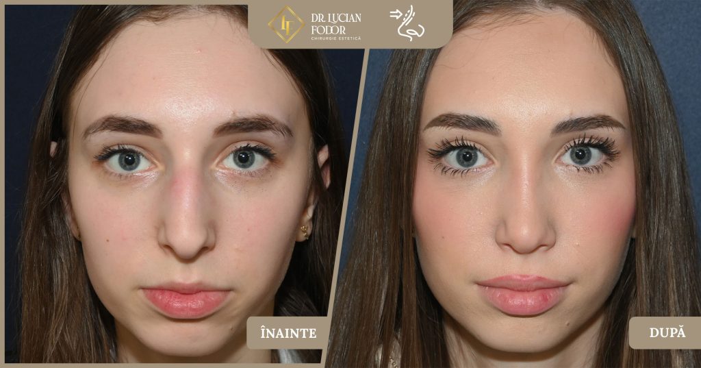 Rinoseptoplastie pentru corectarea unui nas hipertrofiat cu cocoașă și vârf nedefinit - Caz 264 Foto 2