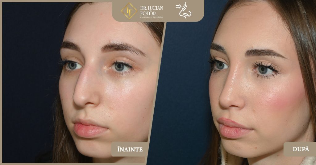 Rinoseptoplastie pentru corectarea unui nas hipertrofiat cu cocoașă și vârf nedefinit - Caz 264 Foto 3