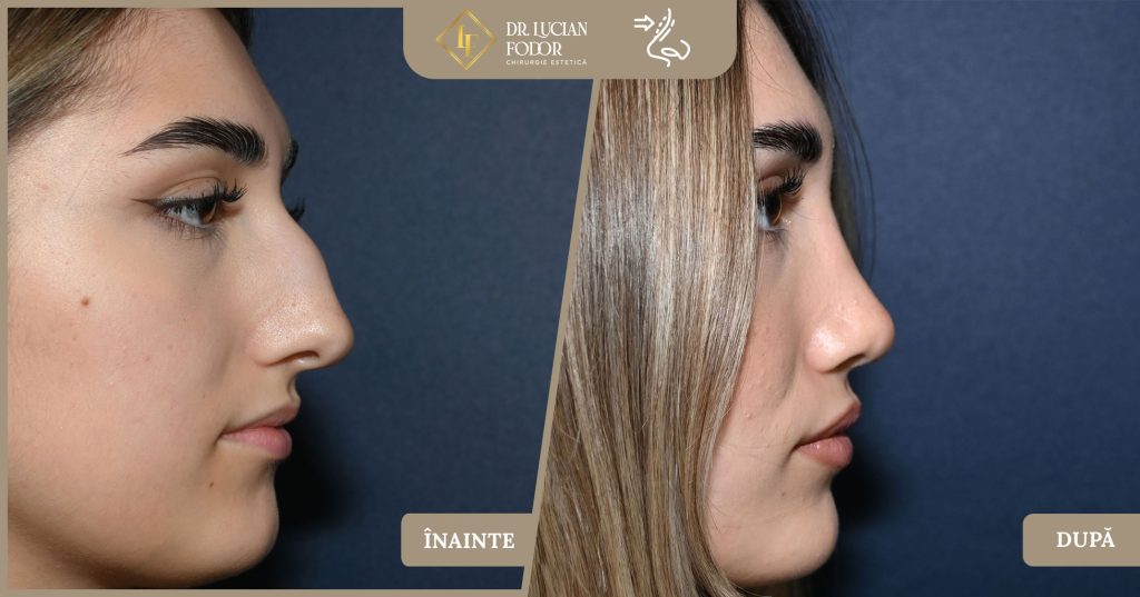 Rinoplastie - Operație nas, Caz 266 Foto 1