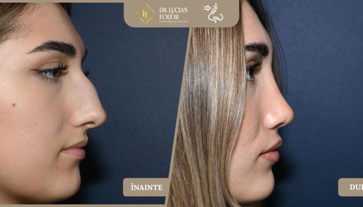 Rinoseptoplastie închisă – Nas asimetric, deviat, cu cocoașă și vârf coborât – Caz 266