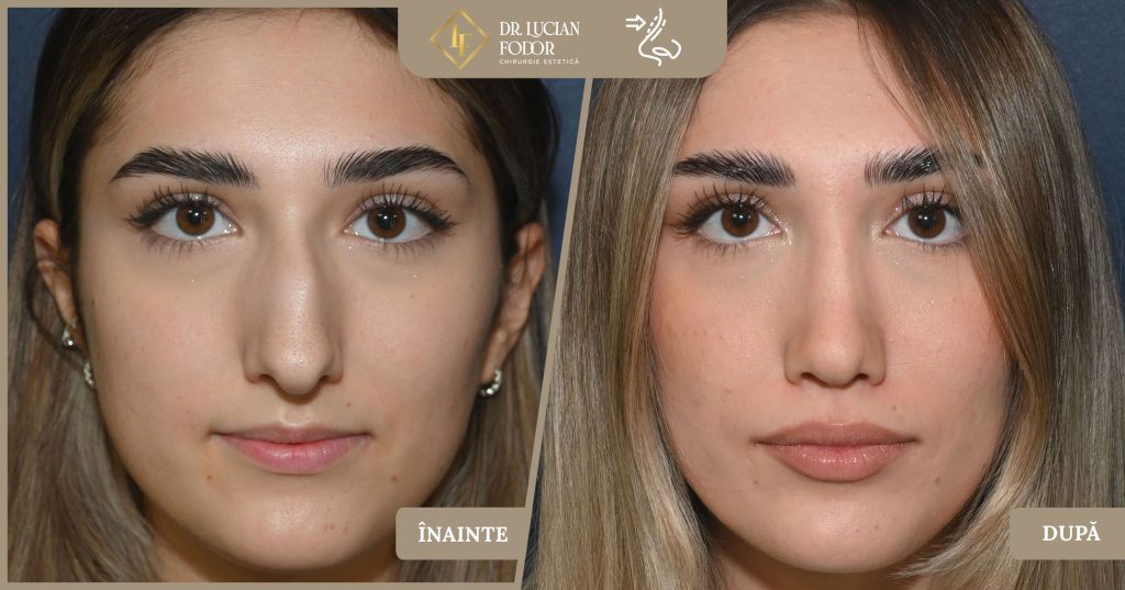 Rinoplastie - Operație nas, Caz 266 Foto 2